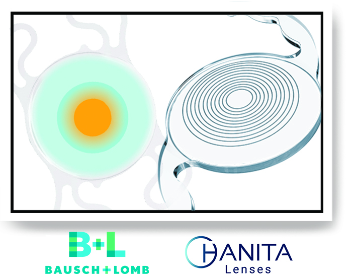 Интраокулярные линзы производства Hanita Lenses и Bausch + Lomb